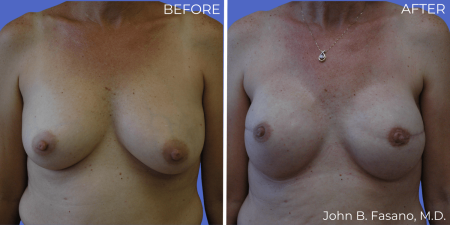 Breast-Reconstruction-BA-06