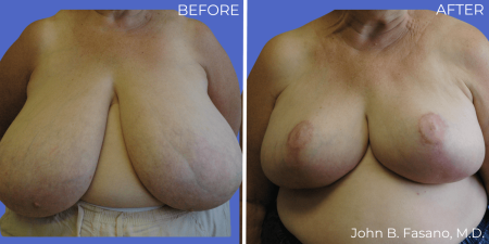 Breast-Reduction-BA-01