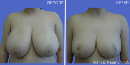 Breast-Reduction-BA-02
