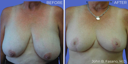 fasano-breast-reduction-before-after