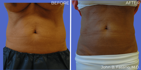 Coolsculpting-BA-01