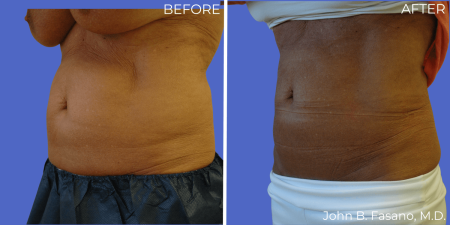Coolsculpting-BA-02