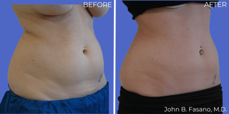 Coolsculpting-BA-03