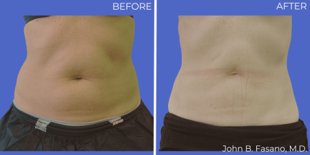 Coolsculpting-BA-04