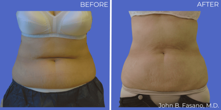 Coolsculpting-BA-05