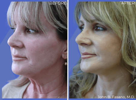 BA-Facelift-John-Fasano