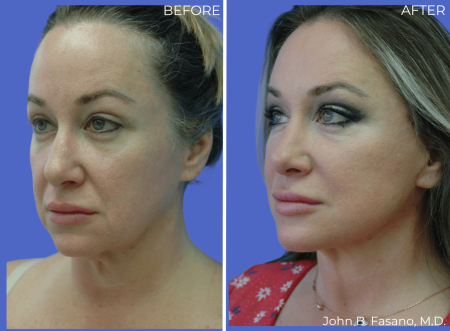 BA-Facelift