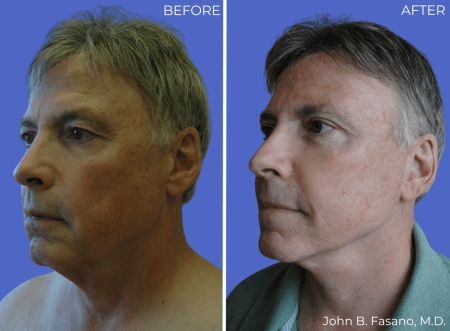 BA-facelift-12