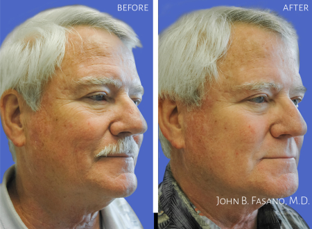 Facelift-Male-1-022020