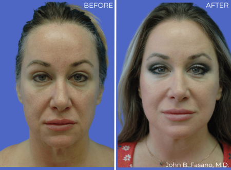 Facelift-by-Dr-Fasano