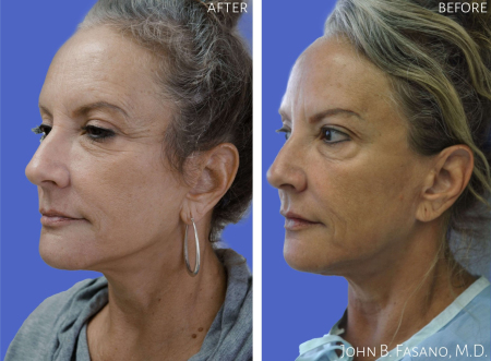 Mini-Facelift-022020