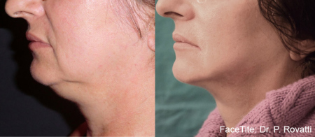 FaceTite Neck 2