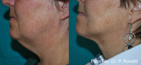 FaceTite Neck 3