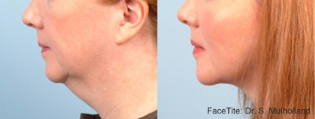 FaceTite Chin 3