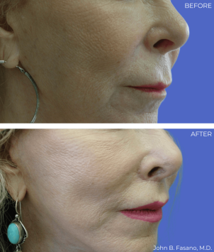 Lip-Lift-BA-Fasano