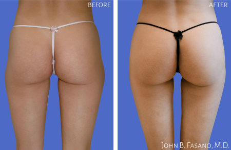 Liposuction-022020